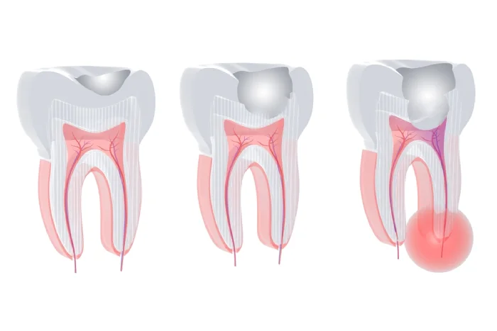 Fases tratamiento endodoncia